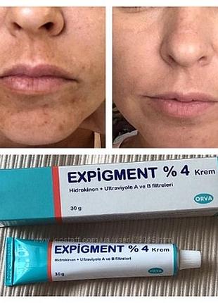 Крем expigment