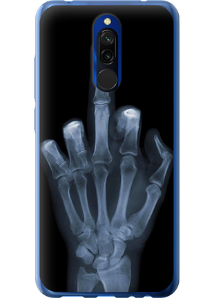Чохол на xiaomi redmi 8 рука через рентген "1007u-1806-851"