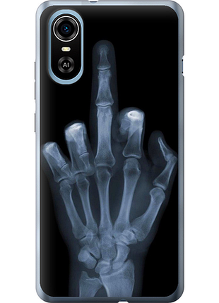 Чохол на zte blade a31 plus рука через рентген "1007u-2637-851"