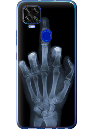 Чохол на zte blade v2020 рука через рентген "1007u-2529-851"