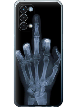 Чохол на oneplus nord n200 5g рука через рентген "1007u-2956-851"