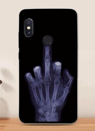 Оригінальний чохол накладка для xiaomi redmi note 5 з картинкою рентген