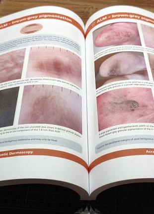 Diagnostic dermoscopy. the illustrated guide. 2nd ed. 2022. 2