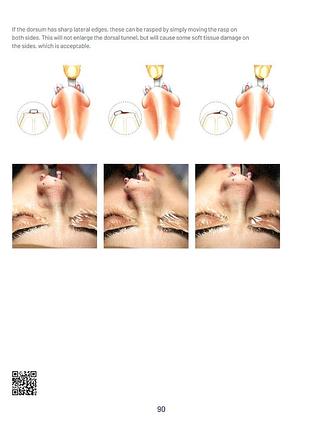 Teorhinoplasty. 2nd ed. 2024. teoman dogan. 4