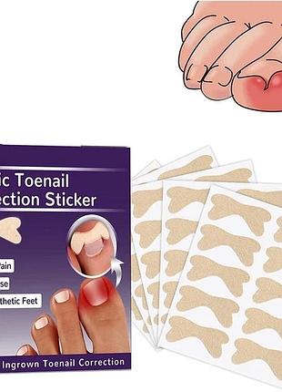 Набір пластирів elastic toenail correction sticker для корекції та усунення врослих нігтів (50 шт.)