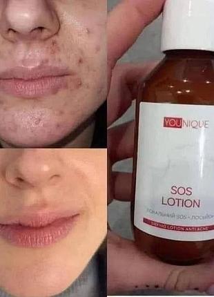 Сироватка для обличчя younique sos-лосьйон для проблемної шкіри jerelia farmasi фармасі 50 мл