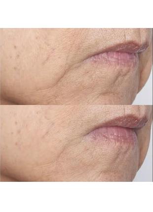 Маска для обличчя perricone md cold plasma plus+ the intensive gel mask 5 мл 2