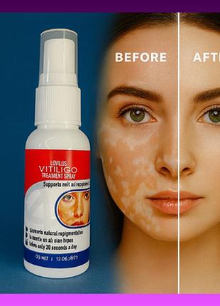 Ефективний лікувальний спрей від пігментації вітиліго vitiligo lovildsa 30 мл для репігментації шкіри