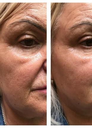 ❤пептидный пилинг с ботокс эффектом dermaquest power peptide resurfacer1 фото