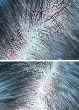 Маска-пилинг для кожи головы с чайным деревом lador tea tree scalp clinic hair pack3 фото