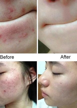 Лекарственное бактерицидное мыло для лечения акне