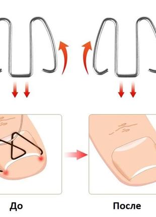 Корректор проволочный на резинке от вросших ногтей (6шт)5 фото