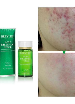 Тоник для лечения акне breylee acne treatment toner 100 мл очищающий поры3 фото