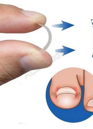 Смужки для вирівнювання врослих нігтів. 10шт/уп