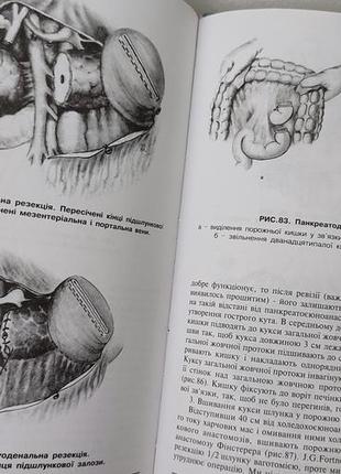 Хірургія посібник - рак підшлункової залози та периампулярної зони - радзіховський бобров мендель7 фото