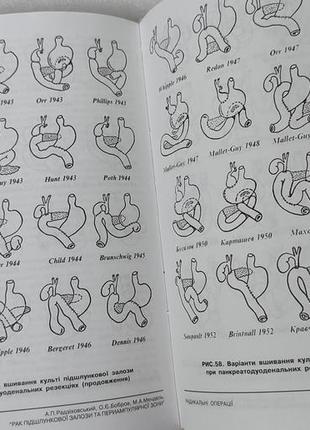Хірургія посібник - рак підшлункової залози та периампулярної зони - радзіховський бобров мендель6 фото