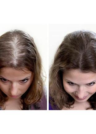 Міноксидил інтелі 2% розчин 60 мл препарат проти випадання волосся