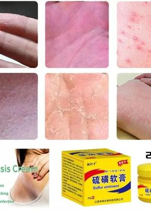 Сіркова мазь від дерматологічних захворювань шкіри
