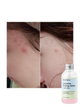 Локальное средство от прыщей и покраснений hollyskin calamine.
